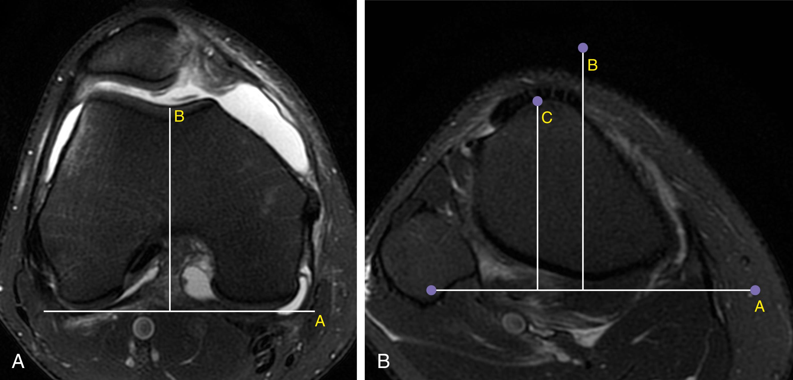 Fig. 28.1, Tibial tuberosity–trochlear groove (TT-TG) distance.