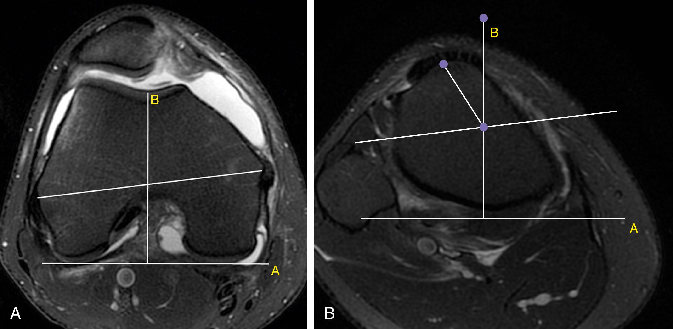 Fig. 28.2, Tibial tuberosity–trochlear groove angle.