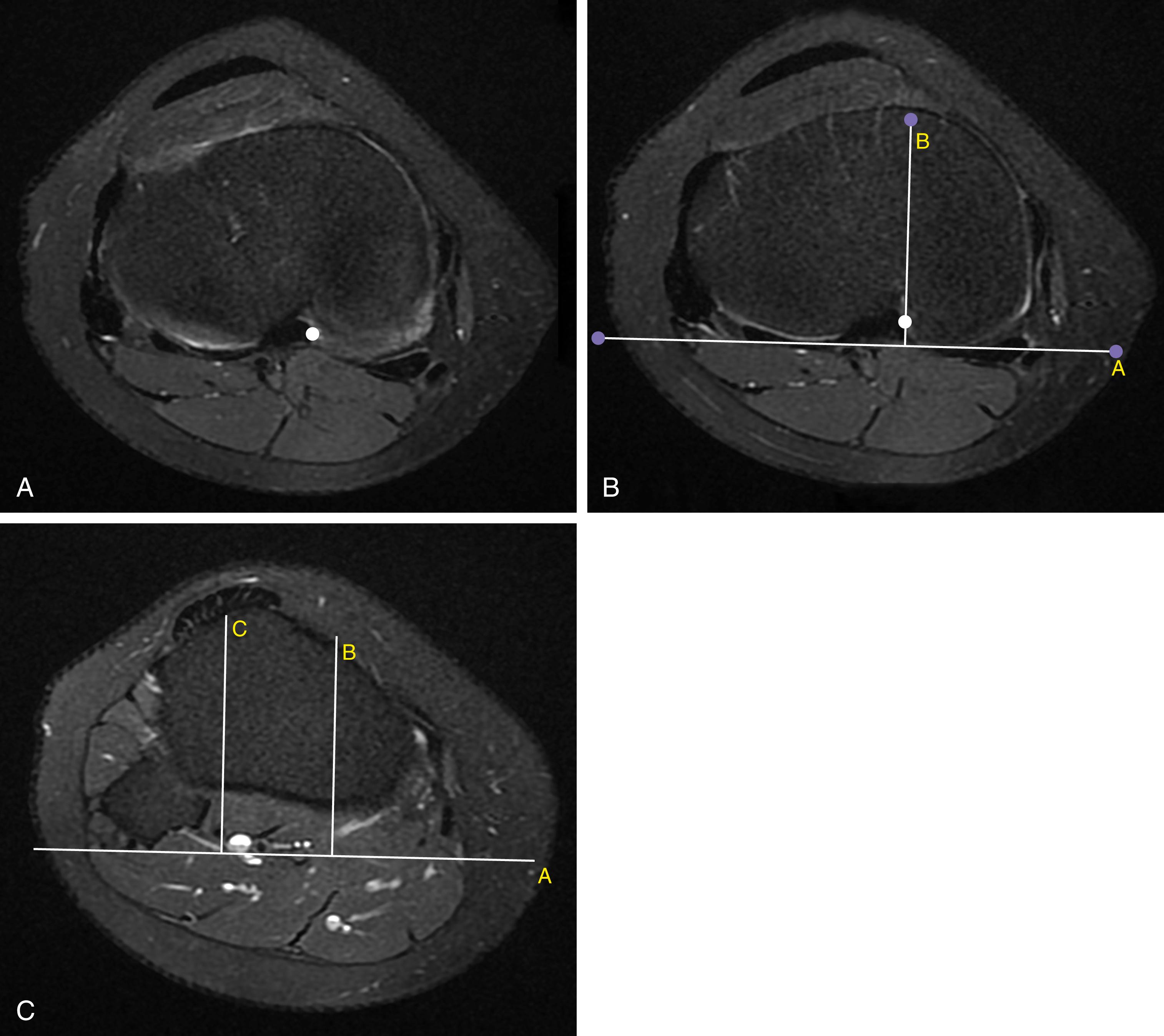 Fig. 28.3, Tibial tuberosity–posterior cruciate ligament (tt-pcl) distance.