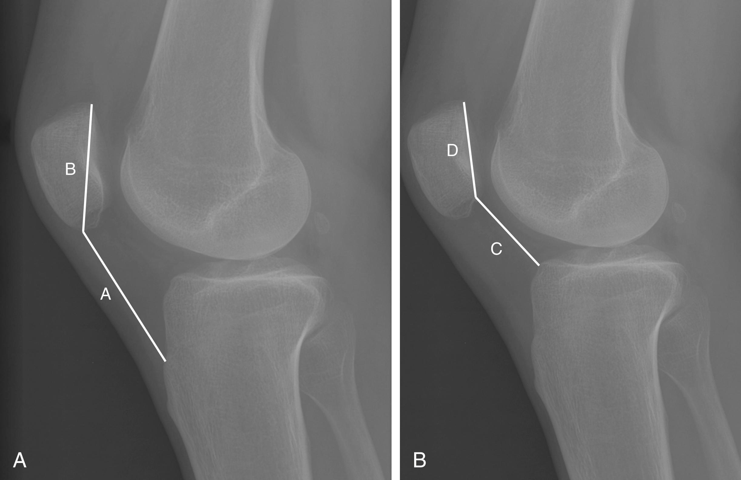 Fig. 28.5, Patellar height measurements.