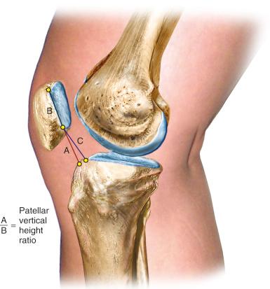 FIG 26-12, Method used to determine patellar vertical height ratio on lateral radiograph. The numerator, line segment A , is the distance between the most ventral (anterosuperior) rim of the tibial plateau and the lowest end of the patellar articular surface. The denominator, line segment B , is the maximum length of the patellar articular surface. An alternative numerator, line segment C , locates the tibial reference point on the middle of the tibial plateau. The patellar vertical-height ratio equals A/B or C/B.