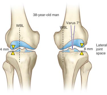 FIG 26-15, Sketch of standing anteroposterior radiograph. The lateral joint space is 8 mm on the left side and 4 mm on the right side. The calculated angular deformity resulting from the 4-mm joint opening is 3.7 degrees of the total 7 degrees of deformity. WBL , Weight-bearing line.