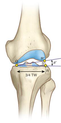 FIG 26-16, The effect of abnormal lateral joint opening on varus angular deformity. With a varus moment applied through a fulcrum, or center of rotation (Q), lateral joint space opening (S) occurs in the presence of slack lateral soft tissues resulting in an additional α degrees of varus angular deformity. TW, Total width tibial plateau.