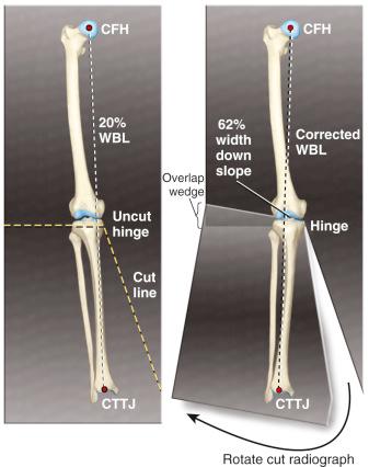 FIG 26-19, An alternative method used to calculate the correction angle of a high tibial osteotomy using a full-length anteroposterior radiograph of the lower extremity. The radiograph is cut to allow the center of the femoral head (CFH), the 62% coordinate, and the center of the tibiotalar joint (CTTJ) to become collinear. The angle of the resulting wedge of radiograph overlap equals the desired angle of correction. The example is provided for a closing wedge osteotomy. The same technique is used for an opening wedge osteotomy in which the medial tibial opening wedge is made to obtain the desired correction. WBL, Weight-bearing line.