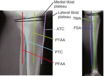 FIG 26-20, Some reported radiographic techniques to measure the tibial slope. The values obtained depend on the anatomic site selected on the tibia. Selected literature references for reported values are shown in Table 26-3 . ATC , Anterior tibial cortex; FSA , fibular shaft axis; PFAA , proximal fibular anatomic axis; PTAA , proximal tibial anatomic axis; PTC , posterior tibial cortex; TMA , tibial mechanical axis.
