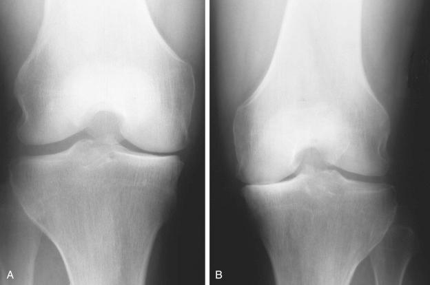 FIG 26-2, Anteroposterior (AP) radiographs of the right ( A ) and left ( B ) knee in a 45-year-old retired professional football player. The patient's weight was 260 lb. His chief complaint was bilateral medial joint pain with walking. The patient was advised to lose a significant amount of weight to decrease body size. In our opinion, high tibial osteotomy (HTO) is contraindicated in the left knee because of the advanced medial compartment arthritis. However, HTO may be an option in the right knee after achieving a normal body mass index. Many athletes of large stature with varus malalignment undergo medial meniscectomy, continue athletic participation, and rather promptly lose the remaining cartilage in the medial tibiofemoral joint. Patient counseling and close follow-up are necessary.