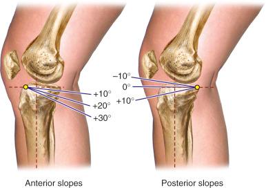 FIG 26-21, The effect of an increase in the tibial slope is shown. The degree of tibial slope is based on proximal tibial anatomic axis.