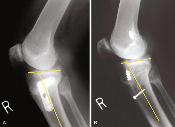 FIG 26-22, Radiographs of a 52-year-old physician referred for treatment after a closing wedge osteotomy ( A ) and subsequent anterior cruciate ligament (ACL) bone-patellar tendon-bone autograft ( B ) that failed. It would have been desirable to correct the abnormal tibial slope, which may have been a factor in the ACL graft failure.