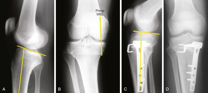 FIG 26-23, A and B, Preoperative radiographs of a 24-year-old man with bilateral severe varus angulation with medial joint line pain. C and D, Postoperative radiographs after a biplanar opening wedge osteotomy that was done to correct the abnormal tibial slope. WBL, Weight-bearing line.