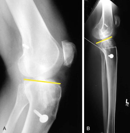 FIG 26-24, A 42-year-old athletic woman sustained an anterior cruciate ligament (ACL) rupture and subsequently underwent an ACL reconstruction that failed for unknown reasons. Two ACL revision reconstructions also failed. She became disabled and had severe giving way with walking and all daily activities. A, Lateral radiograph in which the abnormal posterior tibial slope was not recognized. B, The posterior tibial slope measured on this long-leg radiograph was 22 degrees. The opposite leg had a similar congenital abnormal tibial slope. The patient required a biplanar osteotomy and ACL revision reconstruction.