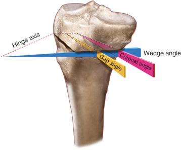 FIG 26-27, The distal portion of the tibia was rotated about an anteroposterior axis, which ran through the hinge point of the osteotomy to maintain the posterior tibial slope. A solid model of a high tibial osteotomy plate was placed at a series of positions around the medial aspect of the tibia, just anterior to the medial collateral ligament. The anteromedial cortex wedge angle is that angle formed along the oblique anteromedial tibial cortex during a prescribed opening wedge osteotomy (coronal plane). The gap angle is formed by planes that are perpendicular to the wedge angle along the anteromedial tibial surface.