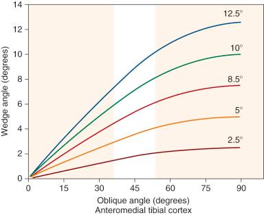 FIG 26-28, The anteromedial cortex opening wedge angle depends on the oblique angle of the tibial cortex with respect to the hinge axis. Each line represents the desired calculated degrees of correction for the opening wedge osteotomy in the true coronal (90-degree) plane.