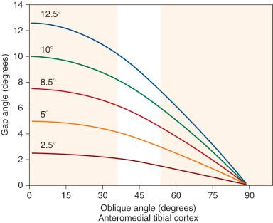 FIG 26-29, The magnitude of the gap angle changes with the obliquity of the anteromedial tibial cortex angle. Each line represents the calculated degrees of correction for the opening wedge osteotomy in the coronal plane.