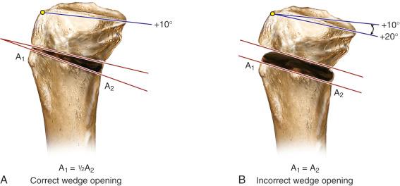 FIG 26-30, A, Appropriate choice of the wedge angle to maintain the sagittal tibial slope. B, Inappropriate wedge angle results in increased tibial slope.