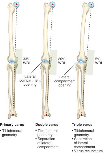 FIG 26-3, Schematic illustration of primary, double, and triple varus knee angulation. WBL , Weight-bearing line.