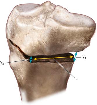 FIG 26-31, The opening wedge angle along the anteromedial tibial cortex can be calculated using the three linear measurements along the osteotomy opening wedge. Y 1 , Gap anterior to Y 2 ; Y 2 , posterior gap; L, length between Y 1 and Y 2 .