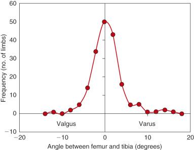 FIG 26-4, Histogram of the data illustrating the relative deviation of limb alignment from a straight line in the normal population of 180 limbs. Of the 90 individuals, 37 had bilateral valgus, 22 had bilateral varus, and 31 had varus alignment of one limb and valgus of the other limb or varus or valgus alignment of one limb and neutral alignment of the other limb.