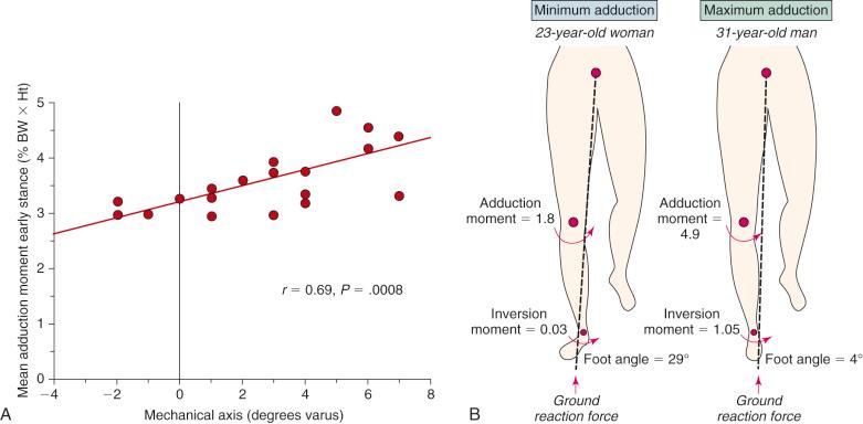 FIG 26-5, The knee adduction moment that produces medial tibiofemoral compartment loading and lateral joint tensile loads is dependent on both the mechanical axis ( A ) and patient gait characteristics such as the rotation of the lower limb and the foot angle at stance phase ( B ). BW, Body weight; Ht, height.