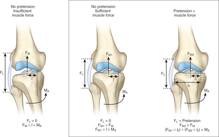 FIG 26-7, A critical interaction between the dynamic muscle forces and the forces in the passive soft tissues is needed to stabilize the knee joint during walking. The knee joint remains closed laterally if either pretension in the lateral soft tissues or increased muscle force resulting from antagonistic muscle groups is present. Distances l and l 1 = 20 mm; l 2 = 60 mm. F l , Soft tissue force; F M , F M1 , F M2 , muscle forces; M A , adducting moment.