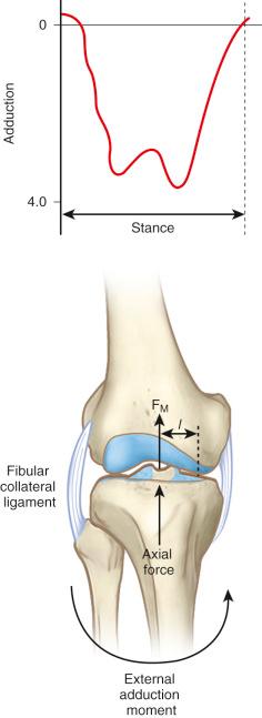 FIG 26-8, The external adducting moment is resisted by the minimum sagittal plane muscle force (F m ) and axial load acting over l . Pretension in the lateral soft tissues would maintain equilibrium if the muscle force were insufficient.