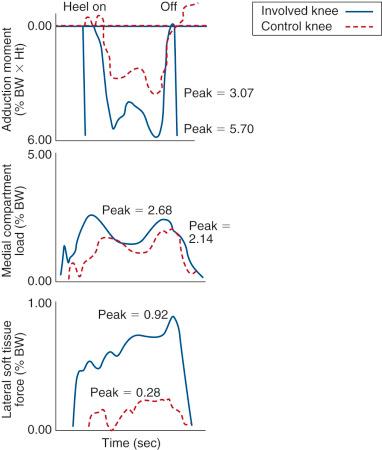 FIG 26-9, The increased adduction moment, medial compartment load, and lateral soft tissue force in an involved knee compared with a control knee. BW , Body weight; Ht, height.