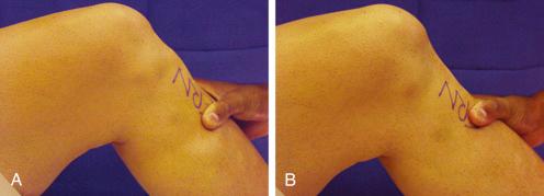 FIG 26-10, Manual knee tests. A and B, Posterior drawer test at 90 degrees of knee flexion. C, Lachman test. D, Valgus manual test for medial joint opening. E, Varus manual test for lateral joint opening. Dial test at 90 degrees of knee flexion in neutral tibial rotation ( F ) maximum external tibial rotation ( G ). Varus recurvatum in the supine ( H ) and standing ( I ) positions.