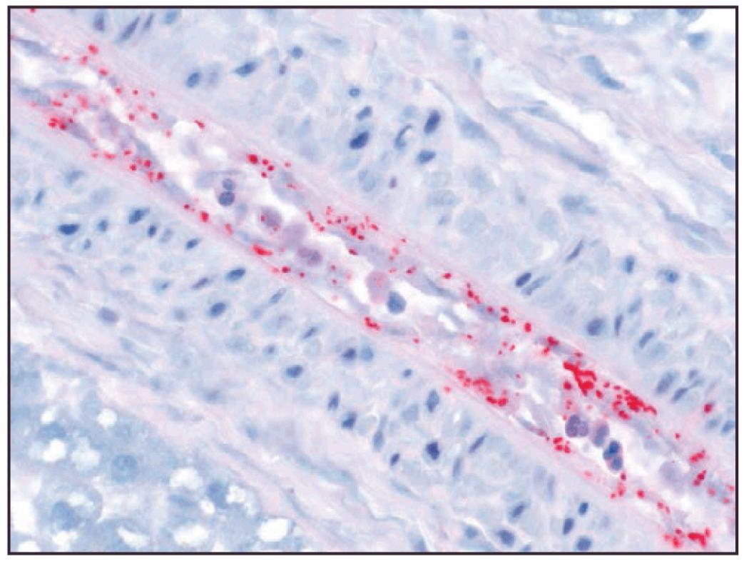 FIG. 296.11, Rickettsia rickettsii tissue biopsy specimen, with immunohistochemical stain.