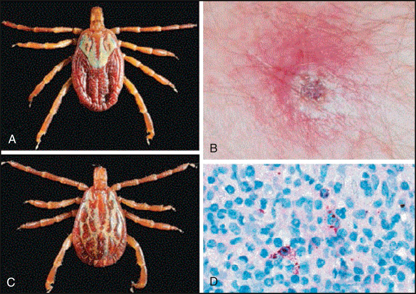 FIG. 296.12, Rickettsia parkeri rickettsiosis, preferred tick vectors, eschar, and immunohistochemical stain of tissue biopsy.