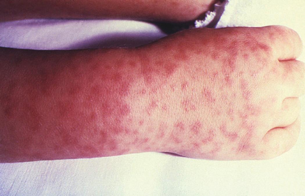 FIG. 296.13, Characteristic initial distal maculopapular-petechial rash of Rocky Mountain spotted fever.