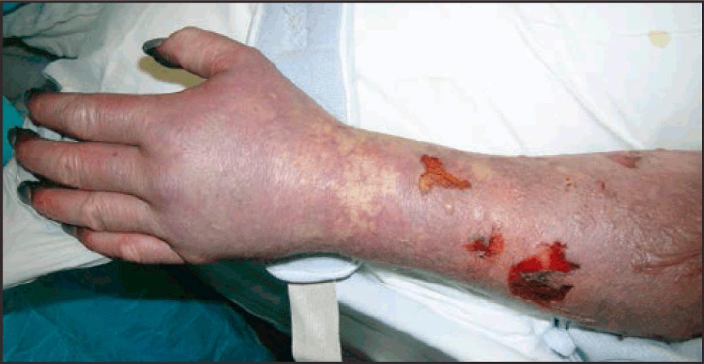 FIG. 296.14, Digital ischemia with gangrene resulting from Rocky Mountain spotted fever.