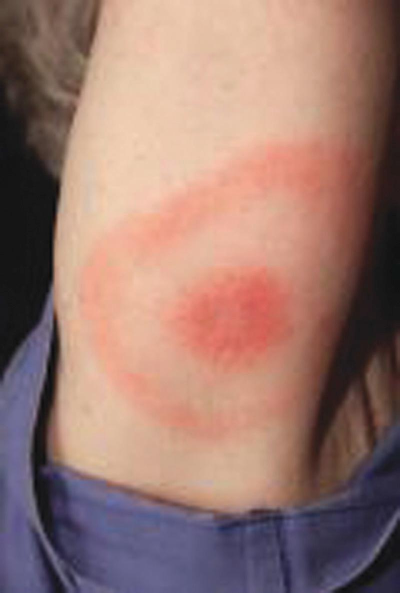 FIG. 296.9, Erythema migrans.