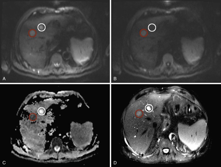 FIG 7-1, A 49-year-old man with metastatic renal cell cancer to the liver, as well as a hepatic cyst, seen on diffusion-weighted imaging at 3 T, showing a low b value (b 50) in A, a high b value (b 400) in B, and the apparent diffusion coefficient (ADC) map ( C ), as well as T2-weighted image ( D ) series. Note the T2 shine-through effect on A, absent on B for the cyst (white) and the confirmation of true restricted diffusion on C for the metastasis (red).