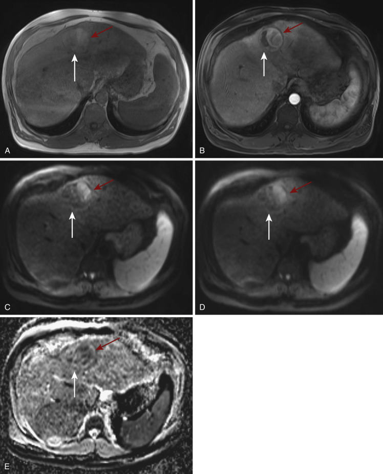 FIG 7-2, A 52-year-old man with hepatocellular carcinoma treated with external beam radiation the previous day on precontrast ( A ) and arterial phase postcontrast ( B ) fat-saturated T1-weighted imaging. Peripheral components of the hepatocellular carcinoma show necrotic transformation (white arrows); due to the high intrinsic T1 signal on precontrast imaging (SI 358), the assessment of the more solid-appearing components to differentiate between treatment change and residual tumor (red arrow) remains challenging (SI 218). Diffusion-weighted imaging at 3 T was performed with low b value (b 50) (cystic 93, solid SI 150) ( C ), high b value (b 800) (cystic SI 33 and solid SI 57) ( D ), and subsequent calculation of an apparent diffusion coefficient (ADC) map (cystic ADC 1333 and solid ADC 650) ( E ). Diffusion restriction in the solid component confirms histopathologically proven residual viable tumor tissue.
