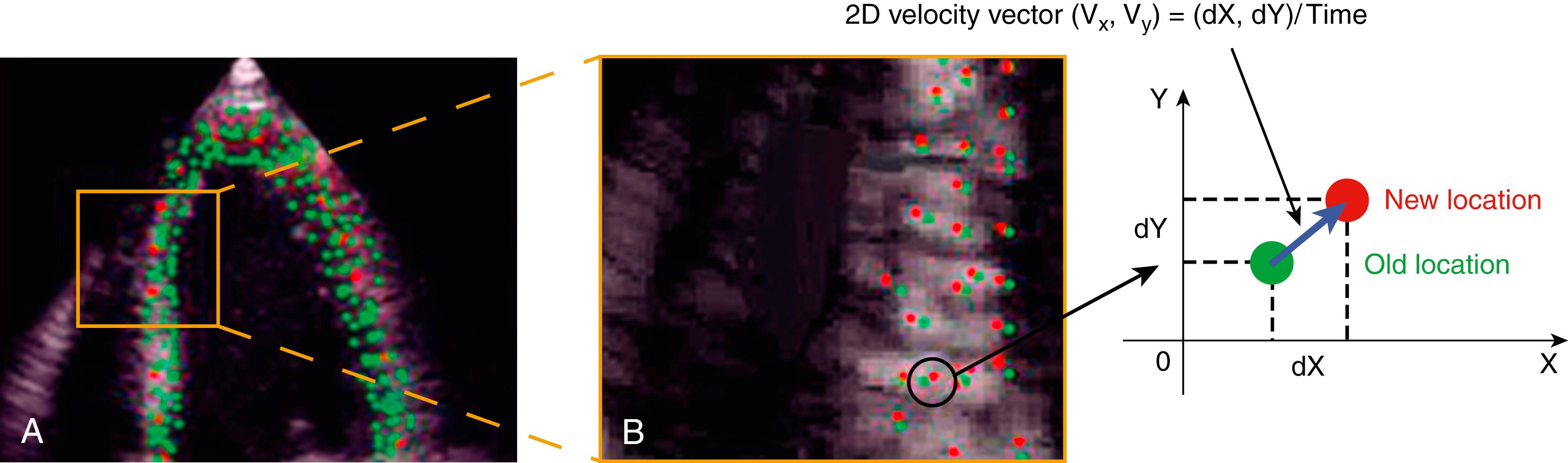 Figure 4.2, Principle of speckle-tracking echocardiography. The strain software identifies natural acoustic makers within the myocardial wall segments ( A ), which is also shown in a zoom image ( B ). The green dot in the graphical representation displays the old location, and the red dot represents the new location of the same natural acoustic marker during two consecutive frames. 2D, Two dimensional.