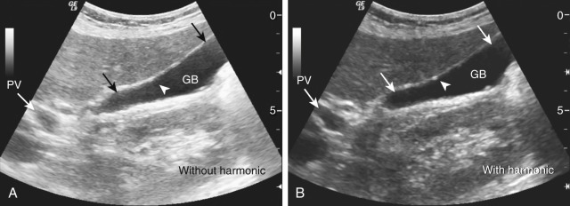 Figure 4-1, Comparison of images in the same location of the right upper quadrant without and with harmonic imaging. A, Image without harmonic imaging: the fundus and neck areas (arrows) of the gallbladder (GB) and intraportal venous area (PV, arrow) appear echogenic and cloudy. B, With harmonic technique, the figure shows a clear GB and portal venous structure. In addition, the tiny calcification on the anterior wall of the GB (arrowhead) is well shown on the harmonic image in B but invisible in the blurred image in A.