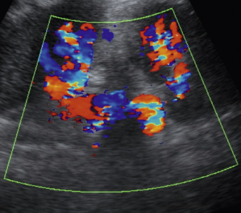 Figure 4-11, Splenorenal collateral vessels. Transverse image of the left kidney shows tortuous collateral vessels between the splenic and renal hila.