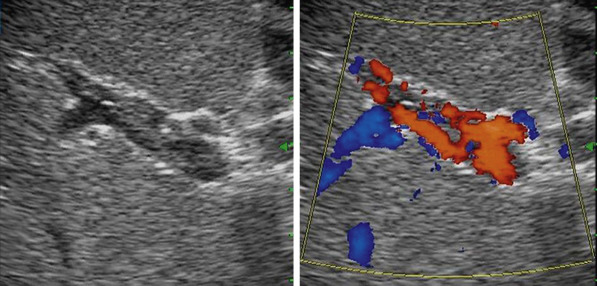 Figure 4-12, Partial portal vein occlusion. Transverse imaging of the portal vein shows echogenic thrombus within the vein with incomplete filling on color flow Doppler imaging.