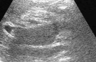 Figure 4-13, Acute portal vein occlusion. Transverse image of the intrahepatic portal vein shows distended portal vein with thrombus within.