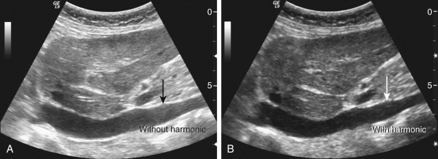 Figure 4-2, Comparison of image conspicuity without/with harmonic imaging in the sagittal plane of the left liver and the long axis of the inferior vena cava (IVC). The arrows point to the intra-IVC area, which is obviously cloudy and blurring in the nonharmonic image (A) compared with the harmonic image (B).