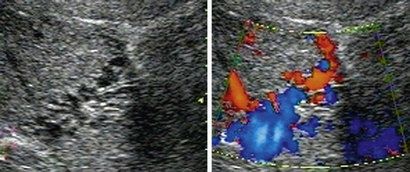 Figure 4-3, Transverse Doppler imaging centered at midclavicular line reveals multiple collateral vessels in the porta hepatis that mimic dilated intrahepatic biliary radicles.