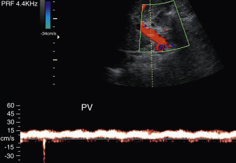 Figure 4-4, Normal portal vein (PV). Pulsed Doppler image of the portal vein shows normal undulating signature pattern with phasic flow. Peak systolic velocity = 15 cm/s.