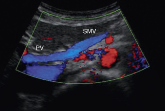 Figure 4-5, Superior mesenteric vein (SMV). Long-axis view shows a normal SMV becoming confluent with the portal vein (PV).