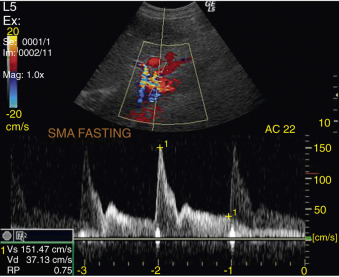 Figure 4-6, Superior mesenteric artery (SMA). Long-axis view shows normal high-resistance waveform patterns of artery in fasting. Peak systolic velocity = 151 cm/s; resistive index = 0.75.