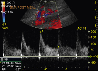 Figure 4-7, Superior mesenteric artery (SMA). Postprandial Doppler image reveals low-resistance waveform pattern with increase in peak systolic velocity. Resistive index = 0.6.