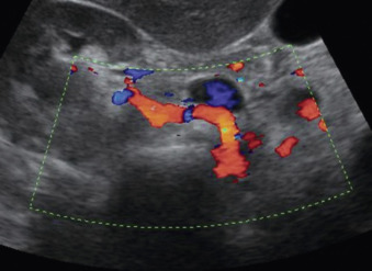 Figure 4-8, Normal right renal artery. Right coronal oblique view with anterolateral transverse approach shows the course of the renal artery from the hilum to the origin.