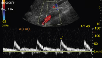 Figure 4-9, Abdominal aorta (AB AO). Long-axis view of the proximal abdominal aorta shows high-resistance flow with brief flow reversal. Doppler angle = 43 degrees.