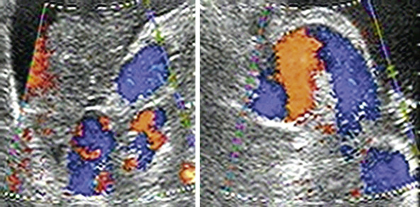 Figure 4-10, Portosystemic collateral vessels. Long-axis view shows large, tortuous, left gastric vein collateral vessels along the inferior border of the left lobe of the liver.