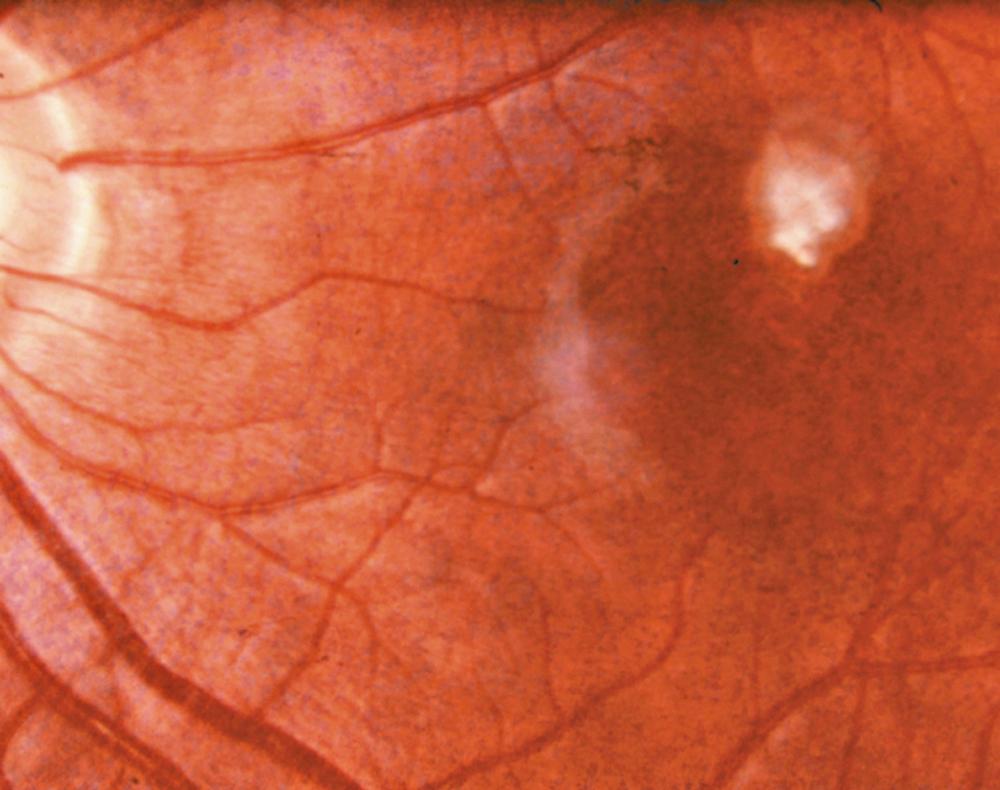 Figure 277.5, Larva of Toxocara in retina that manifests as a granuloma.