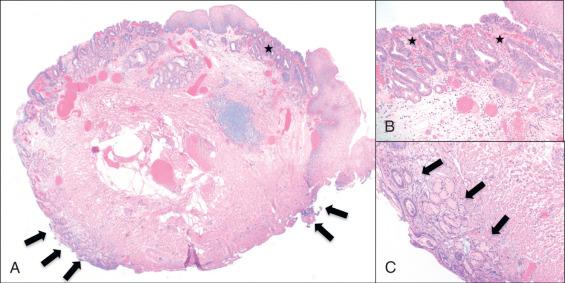 FIG 5.2, A, Microscopic photograph of an endoscopic mucosal resection specimen with high-grade dysplasia in Barrett's esophagus. Arrows point to the lateral mucosal resection margins consisting of squamous (right) and columnar (left) tissue. The star designates a high-grade dysplasia focus, shown at high magnification in B. C, Lateral resection margin showing cauterized Barrett's esophagus but without dysplasia.