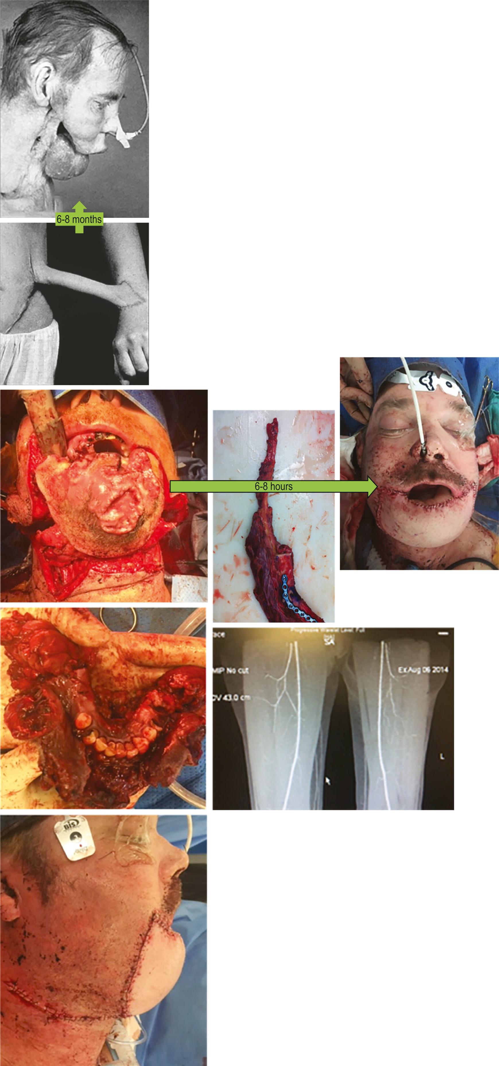 Figure 18.3, Jaw reconstruction that had once been achieved through painstaking pedicled flap surgery was now possible in a matter of hours.